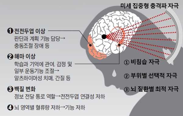 ▲ (자료1) 미세 집중형 충격파 뇌질환 치료법의 특징